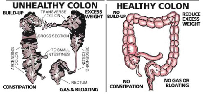 Healthy Colon vs Unhealthy Colon
