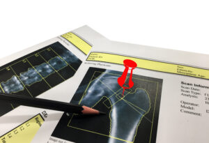 DEXA scans