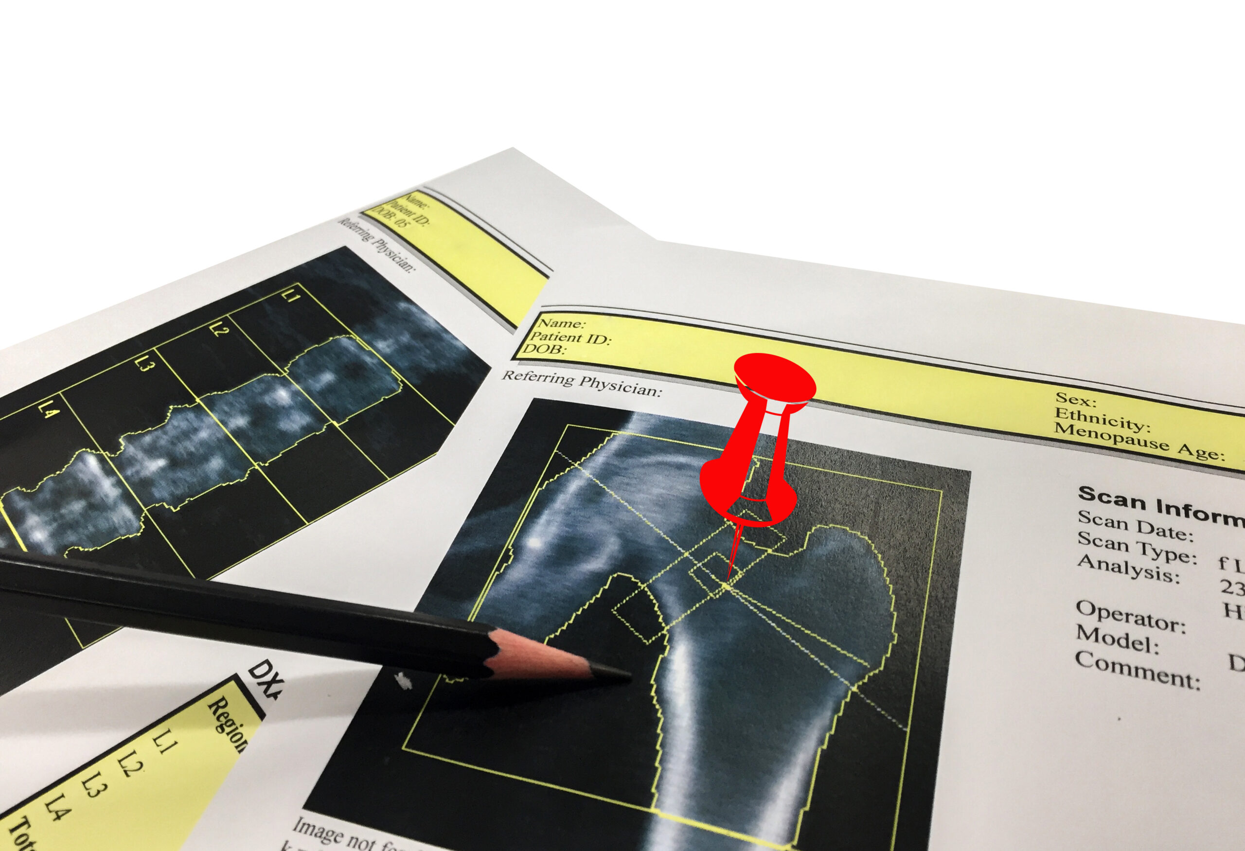 DEXA scans